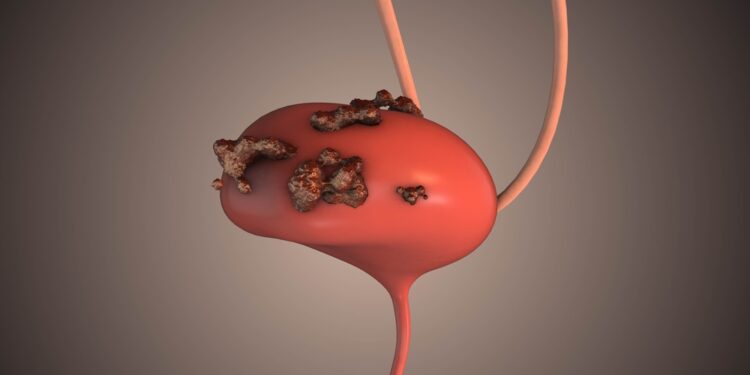 Hemolizinė ureminė (HUS) sindromas: simptomai ir gydymas