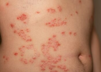 Malasezijos (Pityrosporum) folikulitas: priežastys ir gydymas