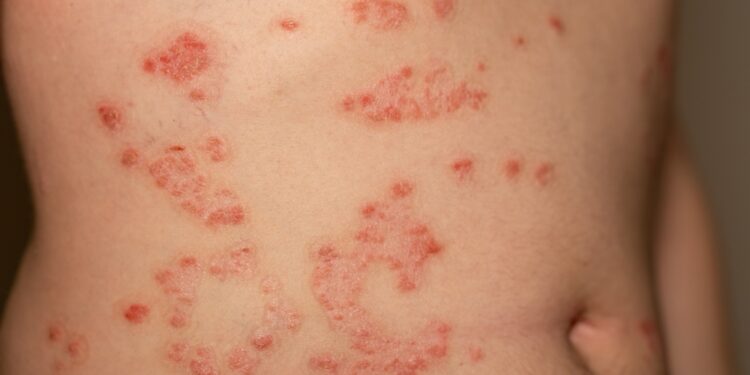 Malasezijos (Pityrosporum) folikulitas: priežastys ir gydymas