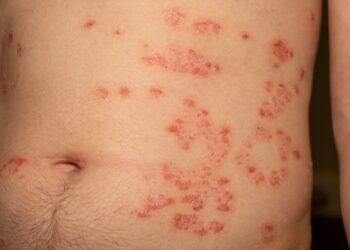 Nokardiozė: priežastys, simptomai, gydymas ir profilaktika