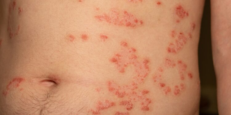 Nokardiozė: priežastys, simptomai, gydymas ir profilaktika