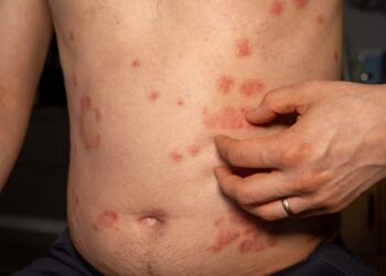 Eritroplakija: priežastys, simptomai ir gydymas