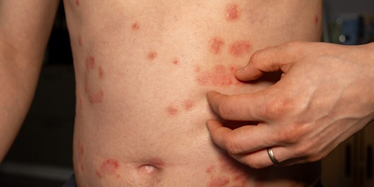 Eritroplakija: priežastys, simptomai ir gydymas