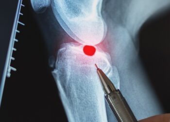 Ekzostozė: tipai, simptomai ir gydymas