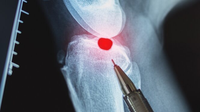 Ekzostozė: tipai, simptomai ir gydymas