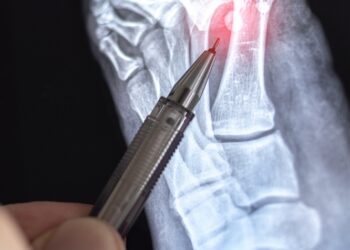 Lisfranco (vidurinės pėdos) sužalojimas: tipai, simptomai ir gydymas