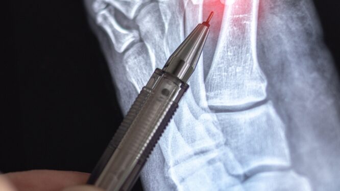 Lisfranco (vidurinės pėdos) sužalojimas: tipai, simptomai ir gydymas