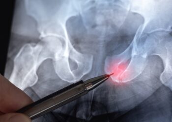 Dubens lūžiai: simptomai, tipai ir gydymas