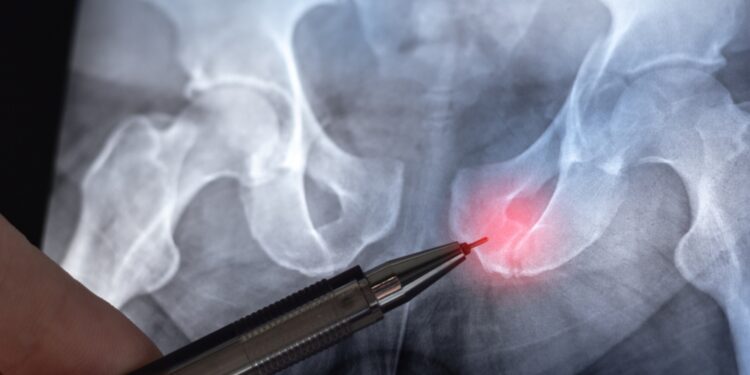 Dubens lūžiai: simptomai, tipai ir gydymas