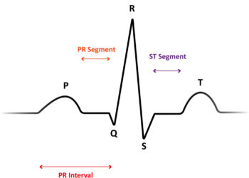 Ilgo QT intervalų sindromas: simptomai ir gydymas