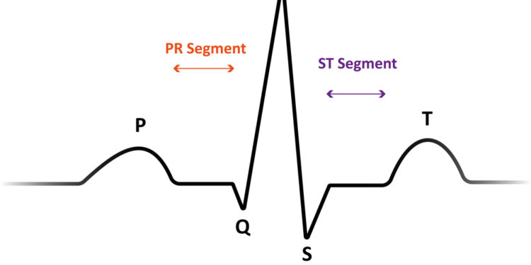 Ilgo QT intervalų sindromas: simptomai ir gydymas