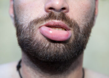 Melkerssono-Rosenthalio sindromas: simptomai ir gydymas