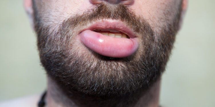 Melkerssono-Rosenthalio sindromas: simptomai ir gydymas