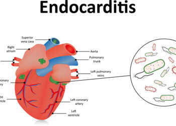 Infekcinis endokarditas (IE): priežastys, simptomai ir gydymas