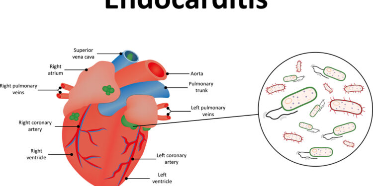 Infekcinis endokarditas (IE): priežastys, simptomai ir gydymas