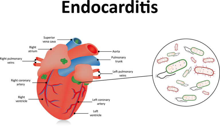 Infekcinis endokarditas (IE): priežastys, simptomai ir gydymas