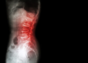 Osteogenesis imperfecta: kas tai, simptomai ir tipai