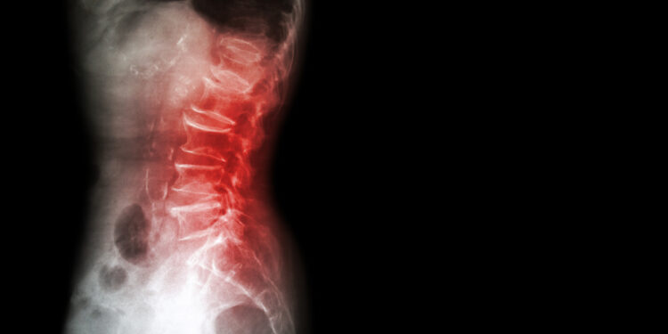 Osteogenesis imperfecta: kas tai, simptomai ir tipai