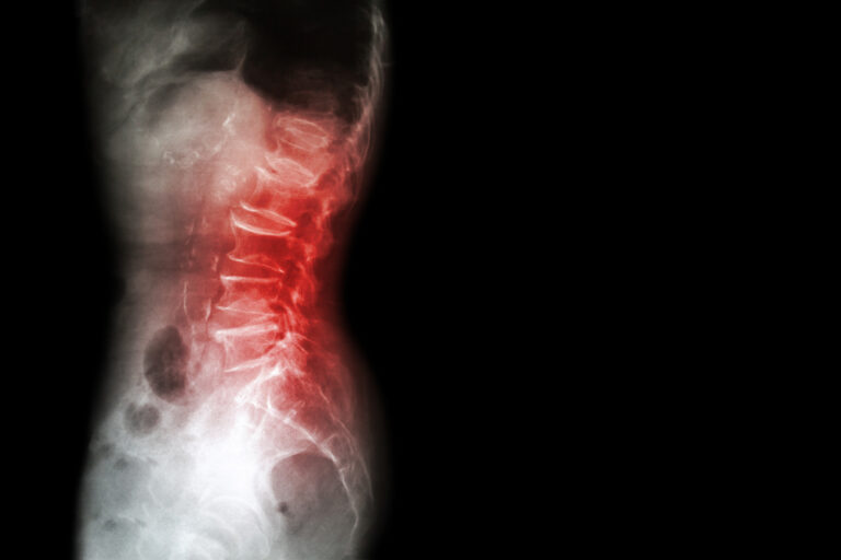Osteogenesis imperfecta: kas tai, simptomai ir tipai