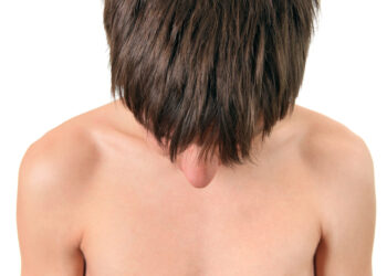 Homocistinurija (HCU): simptomai, priežastys ir gydymas