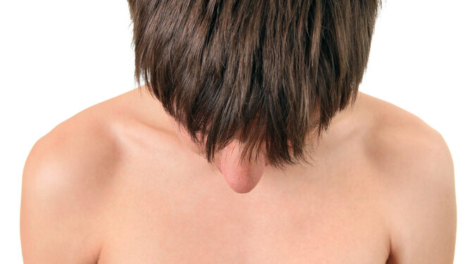 Homocistinurija (HCU): simptomai, priežastys ir gydymas