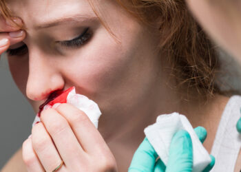 Kraujavimas iš nosies (epistaksis): priežastys, gydymas ir profilaktika