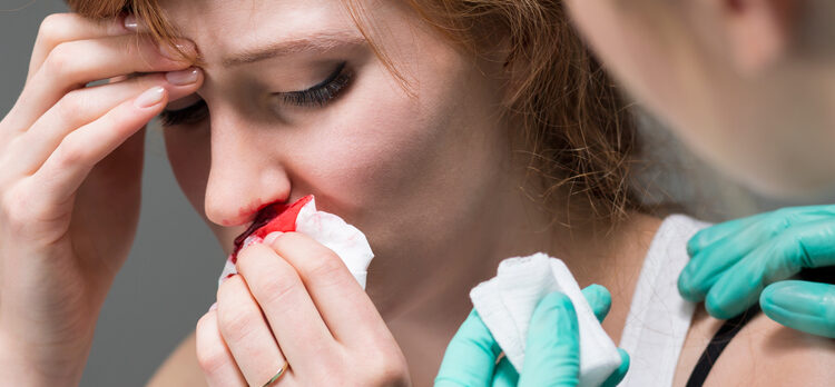 Kraujavimas iš nosies (epistaksis): priežastys, gydymas ir profilaktika