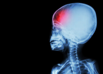 Periventrikulinė leukomalacija (PVL): simptomai ir gydymas