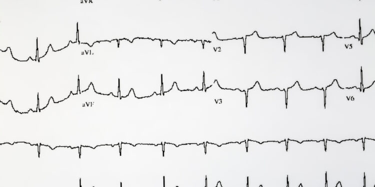 Kairiojo priekinio laidelio blokada: priežastys ir gydymas