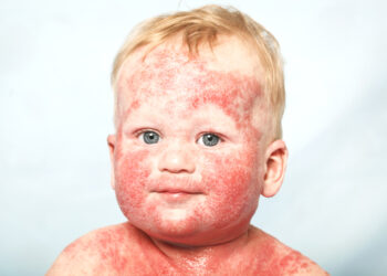 McCune-Albright sindromas: simptomai, priežastys, gydymas ir prognozė