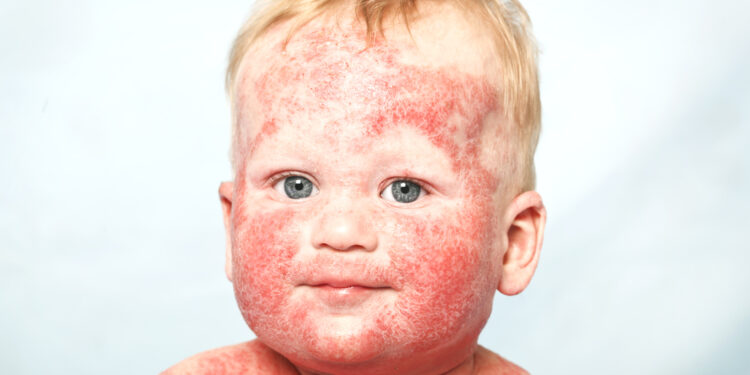 McCune-Albright sindromas: simptomai, priežastys, gydymas ir prognozė