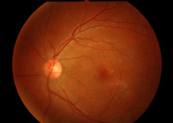 Leberio įgimtoji amaurozė (LIA): simptomai ir priežastys