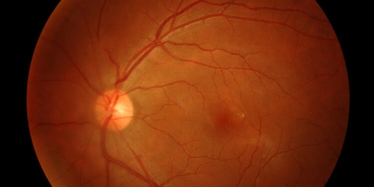 Leberio įgimtoji amaurozė (LIA): simptomai ir priežastys