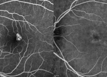 Hollenhorsto plokštelės: priežastys, simptomai ir gydymas