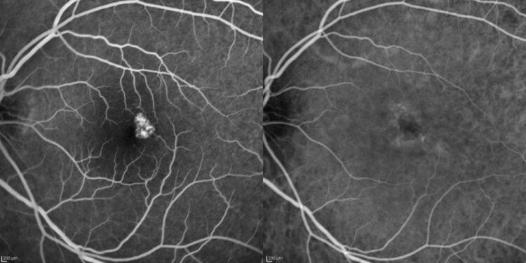 Hollenhorsto plokštelės: priežastys, simptomai ir gydymas