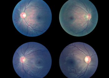Geltonosios dėmės skylė: simptomai, priežastys ir gydymas
