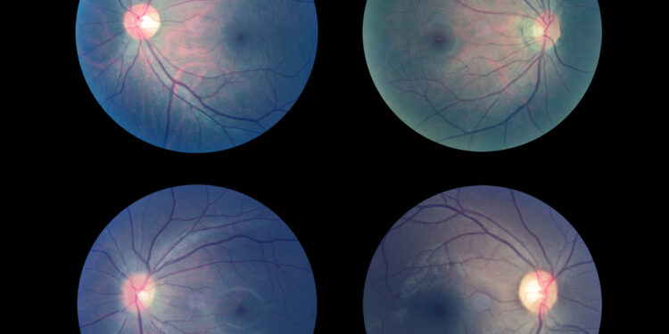 Geltonosios dėmės skylė: simptomai, priežastys ir gydymas