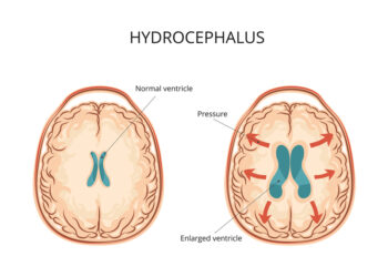 Hidrocefalija: kas tai, priežastys, simptomai, diagnostika ir gydymas