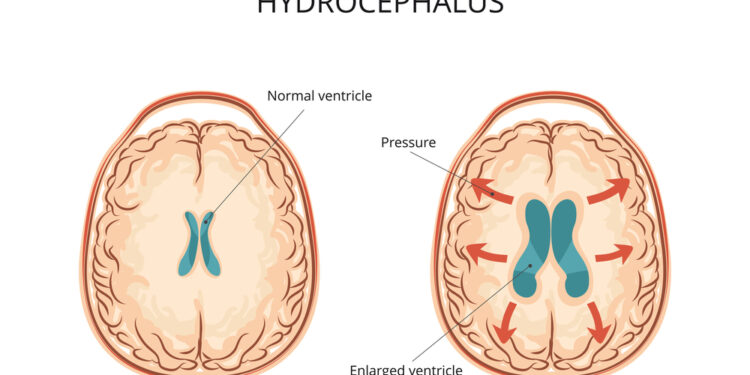 Hidrocefalija: kas tai, priežastys, simptomai, diagnostika ir gydymas