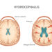 Hidrocefalija: kas tai, priežastys, simptomai, diagnostika ir gydymas