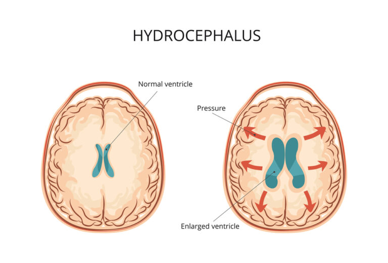 Hidrocefalija: kas tai, priežastys, simptomai, diagnostika ir gydymas