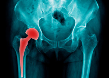 Klubo lūžis: simptomai, rizikos veiksniai ir gijimas