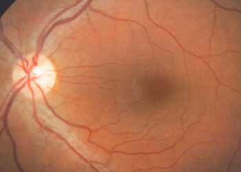 Kearno ir Seiro sindromas: kas tai, priežastys ir diagnostika