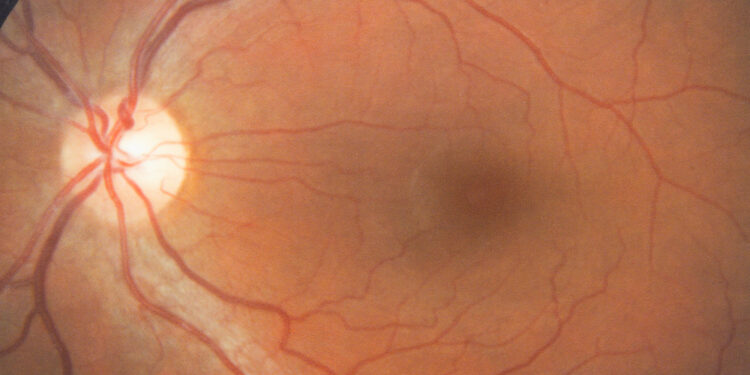 Kearno ir Seiro sindromas: kas tai, priežastys ir diagnostika