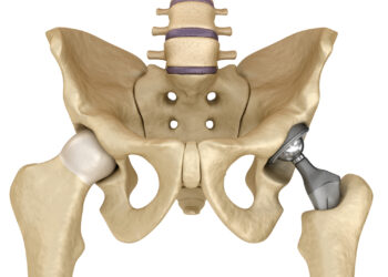 Klubo (šlaunikaulio ir gūžduobės) susidūrimo sindromas: simptomai ir gydymas