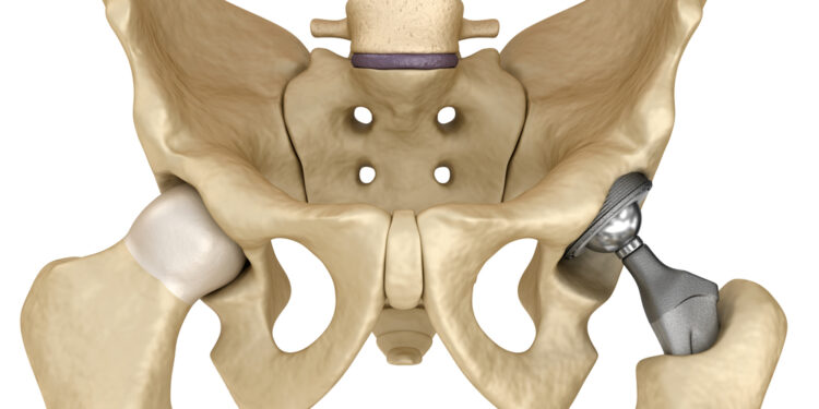 Klubo (šlaunikaulio ir gūžduobės) susidūrimo sindromas: simptomai ir gydymas