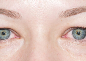 Akių obuolio atrofija (galutinė akies stadija): kas tai, priežastys ir simptomai