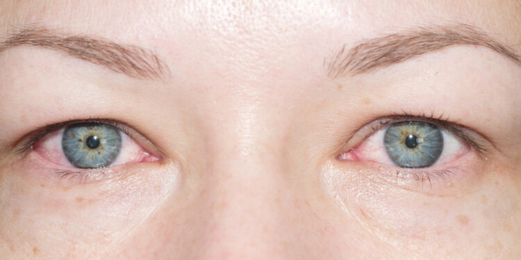 Akių obuolio atrofija (galutinė akies stadija): kas tai, priežastys ir simptomai