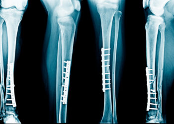 Blauzdikaulio ir šeivikaulio lūžis