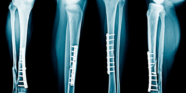 Blauzdikaulio ir šeivikaulio lūžis